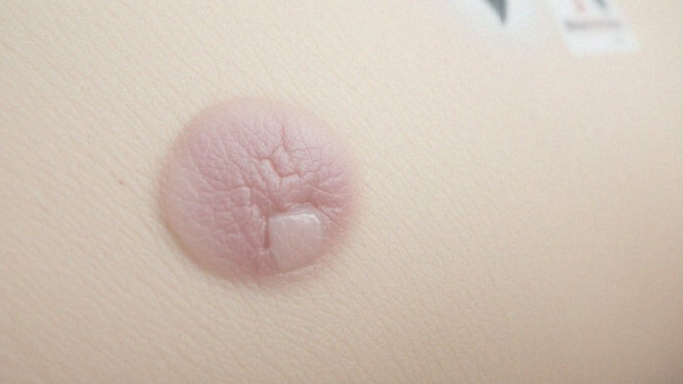 Jakie są różnice między ziarniną a bliznami?